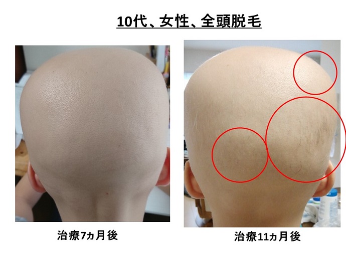 円形脱毛症　病院